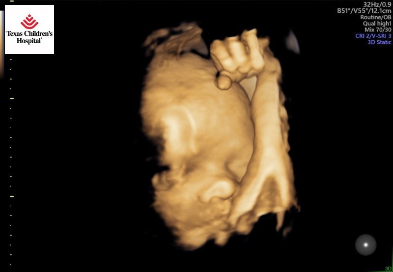 Beau's Ultrasound